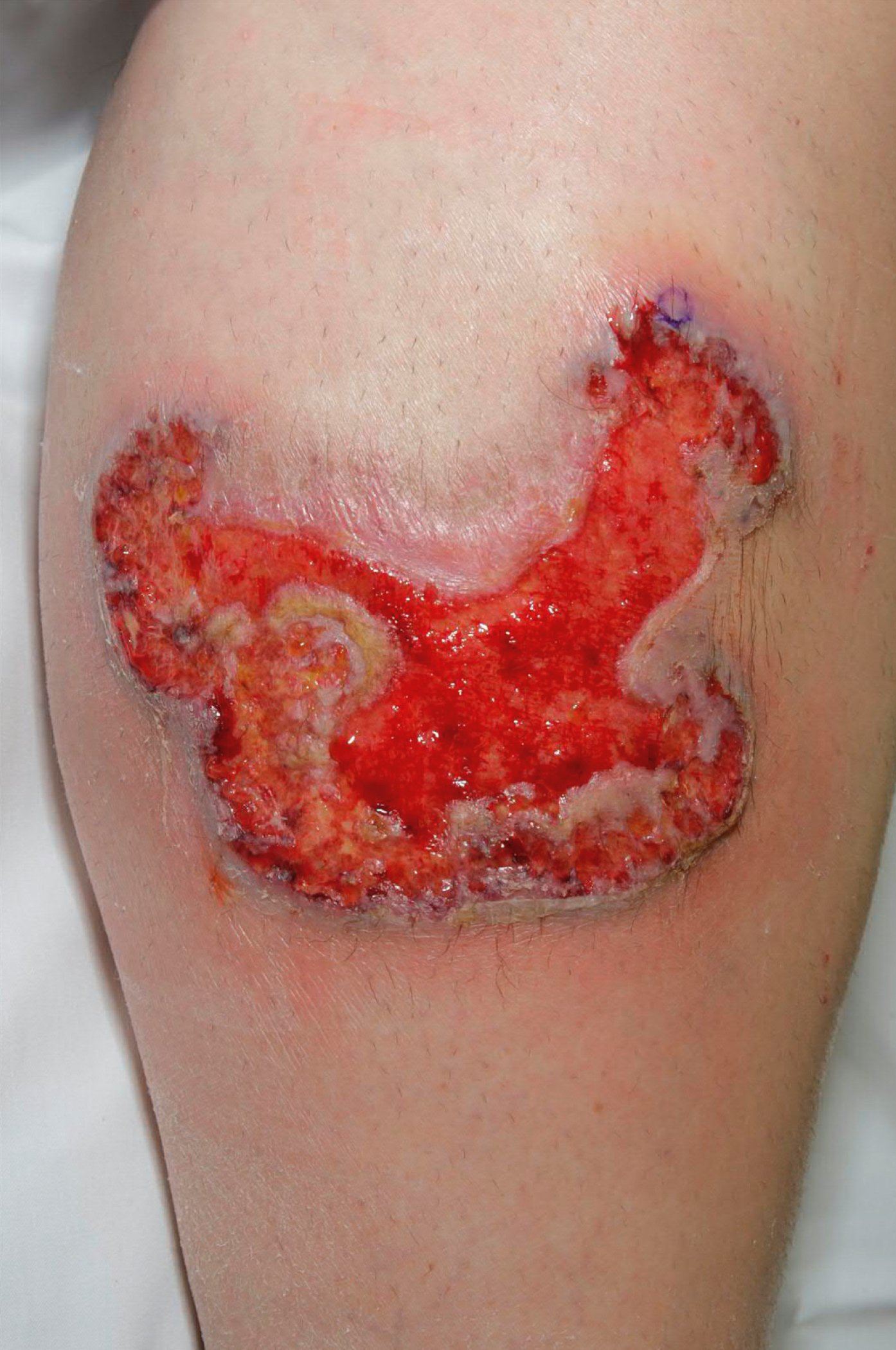 Figure 031_6347.  Ulcerative pyoderma gangrenosum.  Photograph courtesy of Mayo Clinic.  
