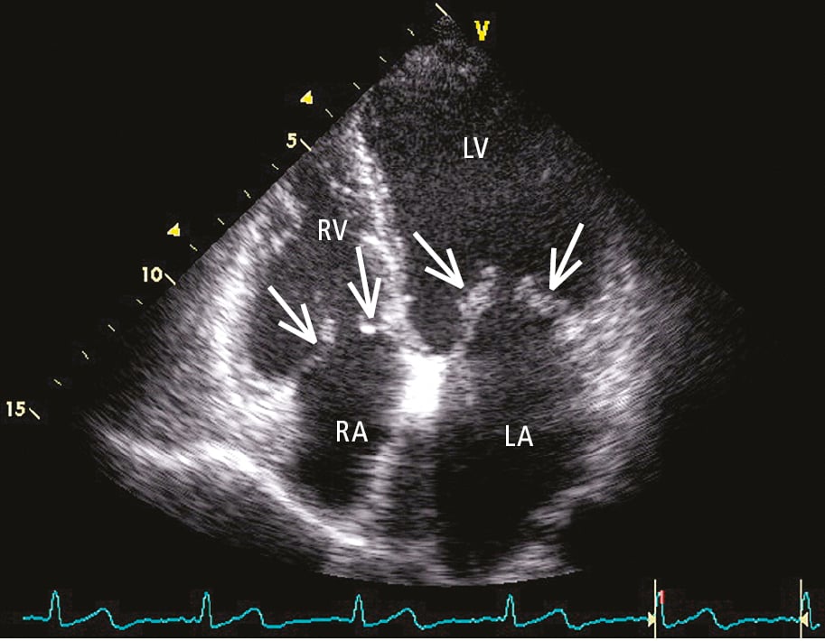 Figure 031_6396.  Transthoracic echocardiography (TTE; apical 4-chamber view): mitral valve disease with tricuspid valve stenosis. Organic lesions of the leaflets with reduced leaflet opening (arrows). LA, left atrium; LV, left ventricle; RA, right atrium; RV, right ventricle. 