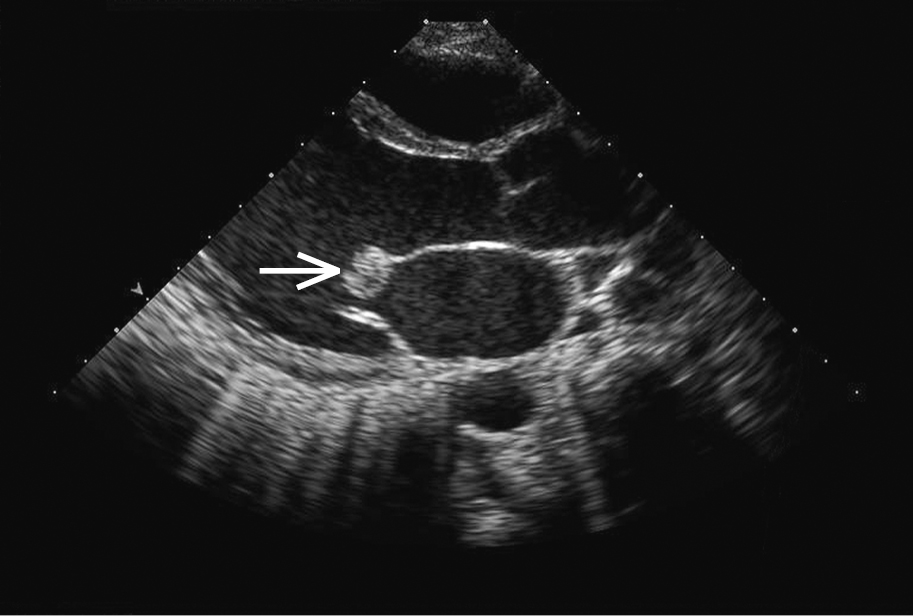 Figure 031_6512.  Transthoracic echocardiography (TTE): a large mobile vegetation (arrow) on the anterior mitral leaflet in a patient with infective endocarditis.  Figure courtesy of Dr Marek Krzanowski.  