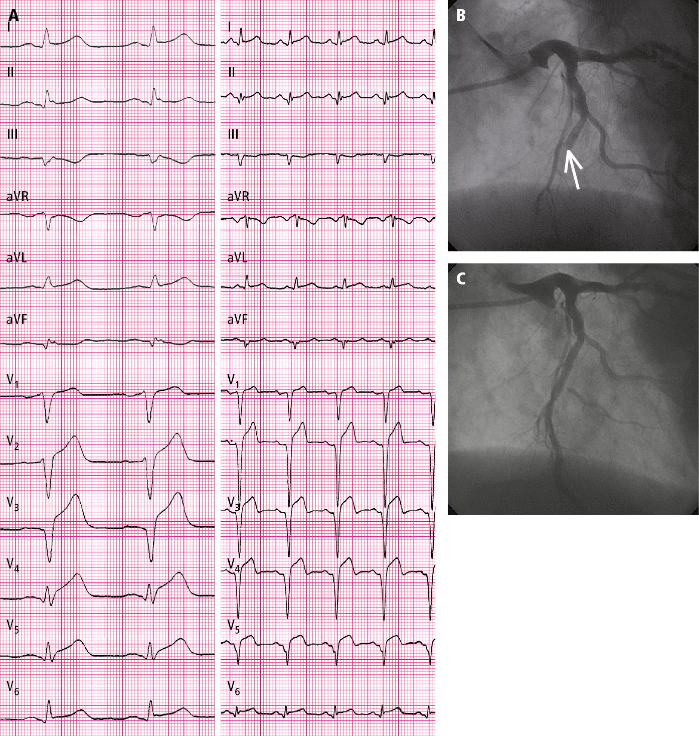 Figure 031_6546.  A 53-year-old patient hospitalized in the second hour of pain:   A  , electrocardiography (ECG) on admission (paper speed, 50 mm/s);   B  , coronary angiography: total occlusion of the left anterior descending artery (arrow);   C  , coronary angiography: left anterior descending artery after percutaneous coronary intervention (PCI) (TIMI grade 3 flow). 