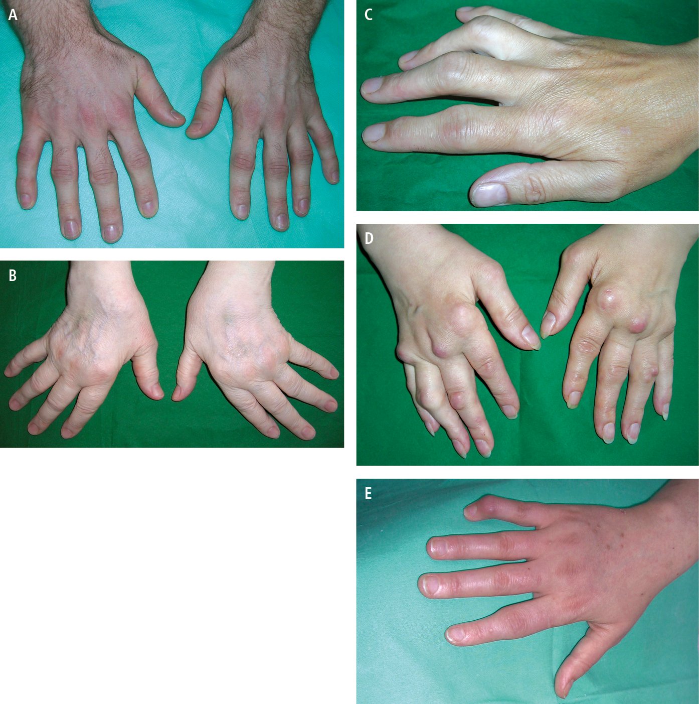 Figure 031_6592.  Rheumatoid arthritis.  A , early changes: symmetric swelling of the metacarpophalangeal and proximal interphalangeal joints.  B , ulnar deviation of the fingers and subluxation of the metacarpophalangeal joints.  C , boutonnière deformity (fingers III and IV).  D , swelling of the metacarpophalangeal and proximal interphalangeal joints, subluxation of the metacarpophalangeal joints, numerous rheumatoid nodules around the joints.  E , swan-neck deformity of the little finger. 