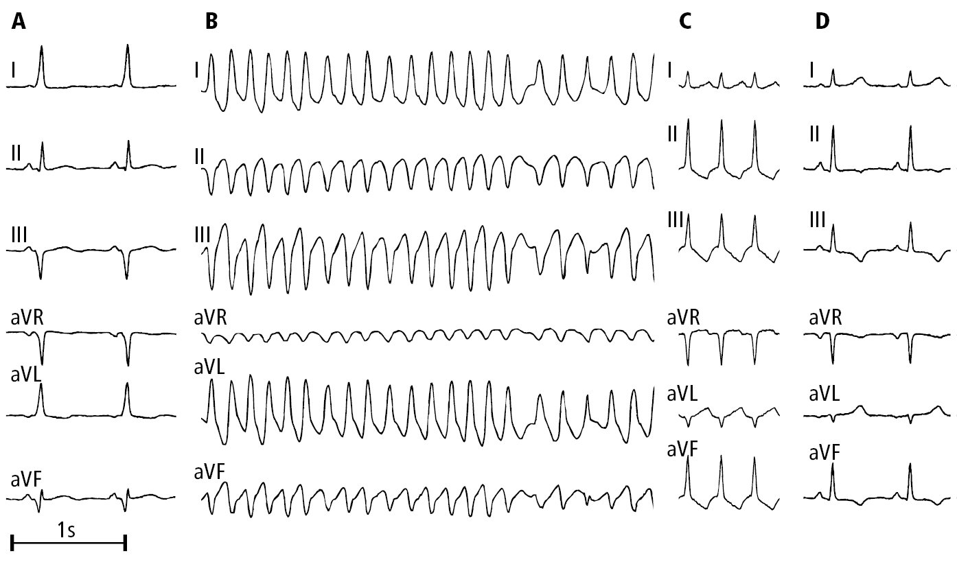Figure 031_6719.  Electrocardiography (ECG) of a patient with Wolff-Parkinson-White syndrome:   A  , sinus rhythm (with preexcitation);   B  , preexcited atrial fibrillation;   C  , orthodromic atrioventricular reentrant tachycardia (AVRT);   D  , status post ablation, sinus rhythm without preexcitation.  Figure courtesy of Dr Andrzej Stanke.  