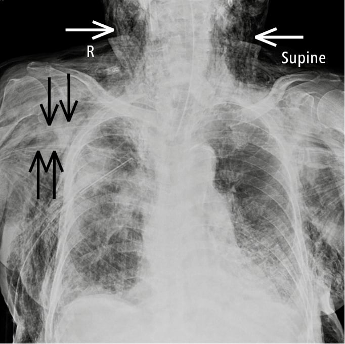Figure 031_6803.  Anteroposterior (AP) chest radiography of a patient with a right-sided pneumothorax (with chest drain insertion) complicated by extensive subcutaneous emphysema. A large amount of air spreads into the subcutaneous tissue around the neck (white arrows) and pectoralis major muscles (black arrows). 