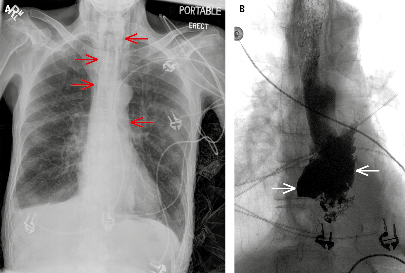 Figure 031_6871.  Chest radiography ( A ) shows pneumomediastinum (red arrows) along the paratracheal soft tissues and aorta. Contrast esophagography ( B ) reveals contrast leakage from the esophagus (white arrows), indicating pneumomediastinum secondary to esophageal rupture. 