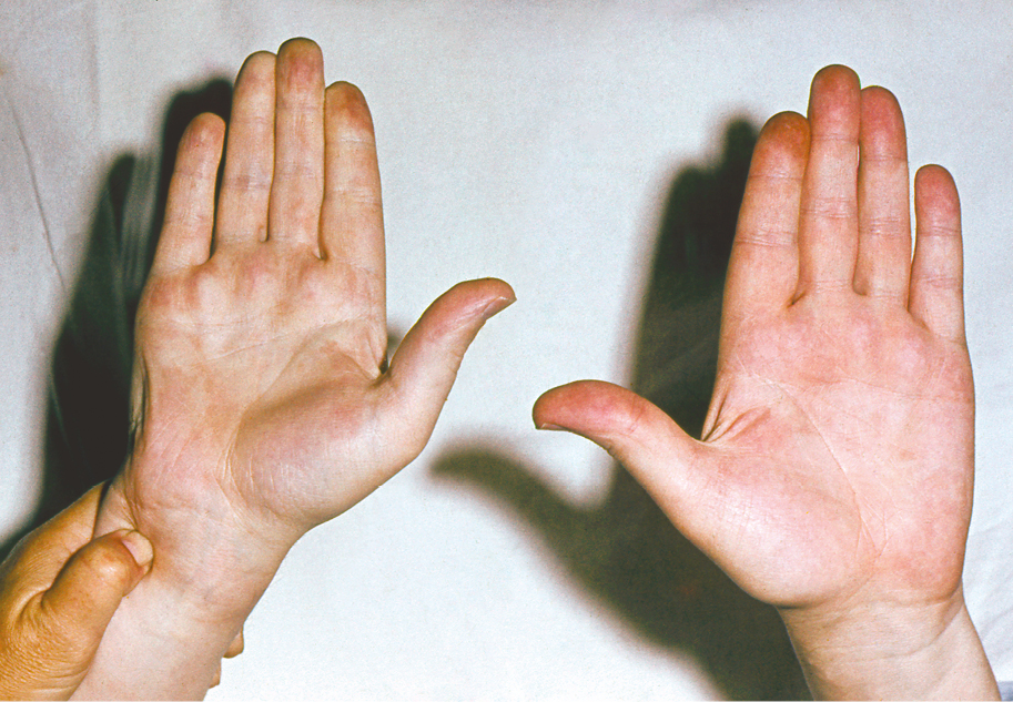 Figure 031_6878.  Testing for the involvement of hand arteries (Allen test). 