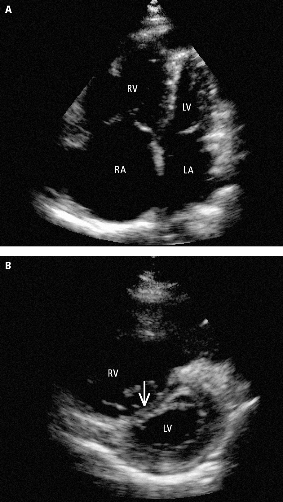 Figure 031_6901.  Transthoracic echocardiography (TTE) of right ventricular overload in a patient with pulmonary embolism:   A  , an enlarged right ventricle dominating the left ventricle seen in the apical 4-chamber view;   B  , flattened interventricular septum (arrow) seen in the parasternal short-axis view. LA, left atrium; LV, left ventricle; RA, right atrium RV; right ventricle. 