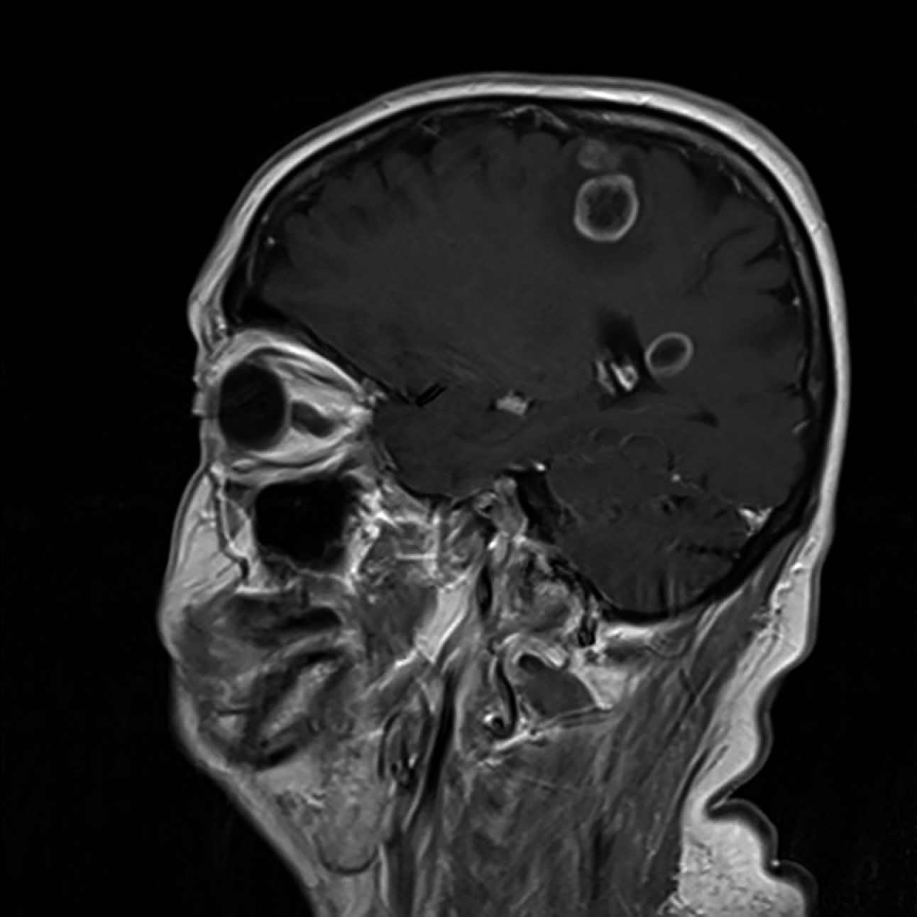 Figure 031_6931.  
MRI of the head: Solitary larvae (cysticerci) of  Taenia solium  in brain tissue. 