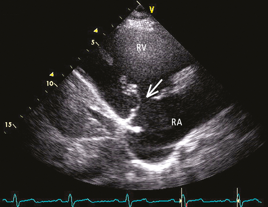 Figure 031_6934.  Transthoracic echocardiography (TTE) (parasternal view on the right ventricular inflow tract): no coaptation of the fibrotic tricuspid valve leaflets (arrow). RA, right atrium; RV, right ventricle. 
