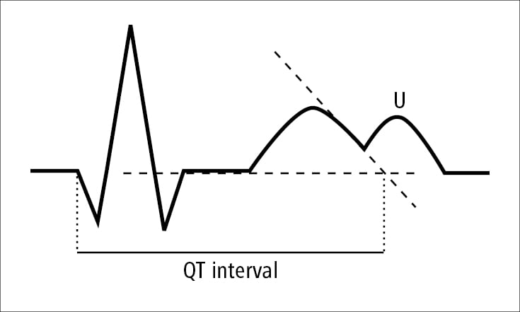 Figure 031_6997.  QT-interval measurement. 