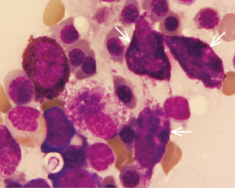 Figure 031_7072.  Mastocytosis: bone marrow smear, visible pathologic mastocytes (arrows; Pappenheim stain). 
