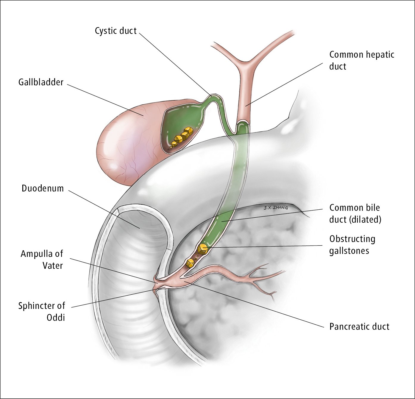 Villous papilloma gallbladder, Hpv and gallbladder