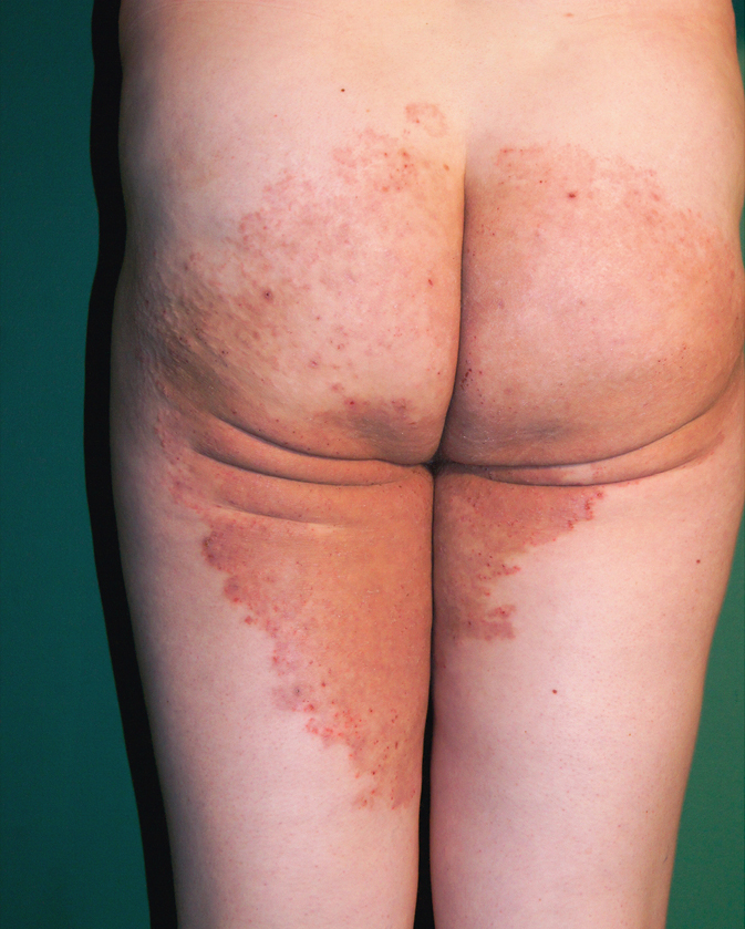 Figure 031_7196.  Glabrous skin mycosis in an adult. Lesions appear in the groins and spread peripherally. Lesions are well separated from the healthy skin, with inflammation exacerbated on the margins and less severe in the central part. 