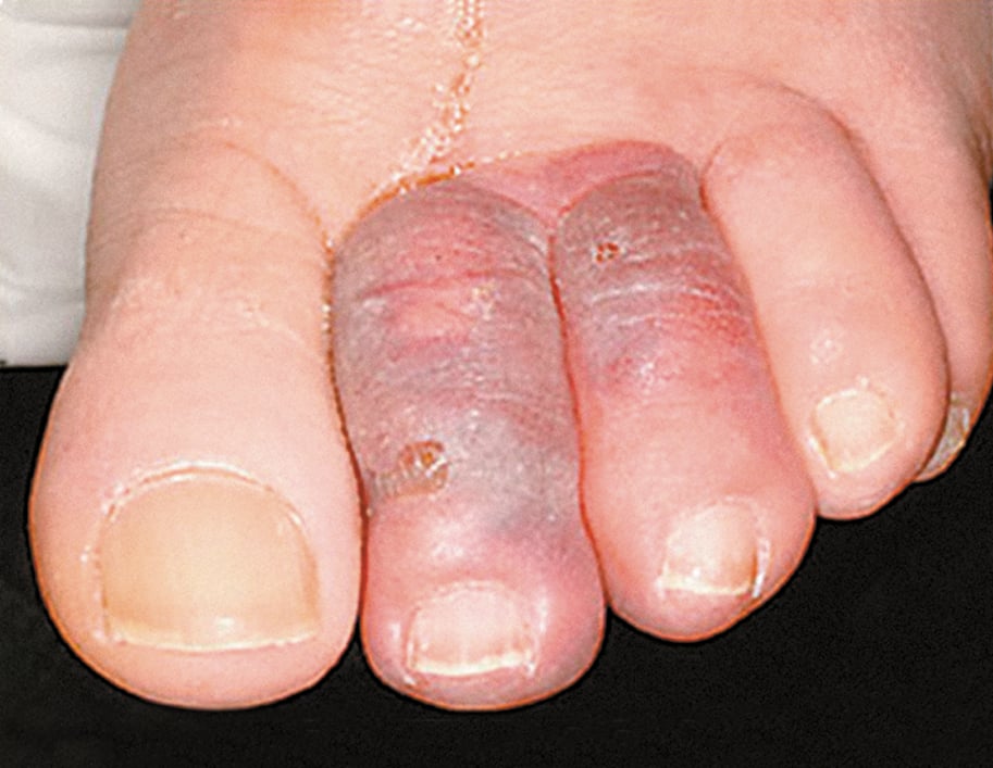 Figure 031_7205.  Arterioarterial embolism: blue toe syndrome (BFS).  Figure courtesy of Dr Leszek Masłowski.  
