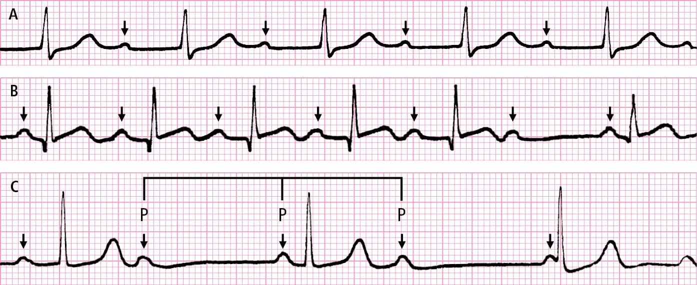 Figure 031_7276.  Atrioventricular (AV) block.  A , prolonged PR interval (first-degree AV block).  B , loss of the QRS complex preceded by progressive prolongation of the PR interval (Mobitz type I [Wenckebach] second-degree AV block).  C , independent rhythm of P waves and QRS complexes (third-degree AV block, AV junction escape rhythm). The PP intervals separated by the QRS complex are shorter than the PP intervals not separated by the QRS complex (arrows indicate P waves). 