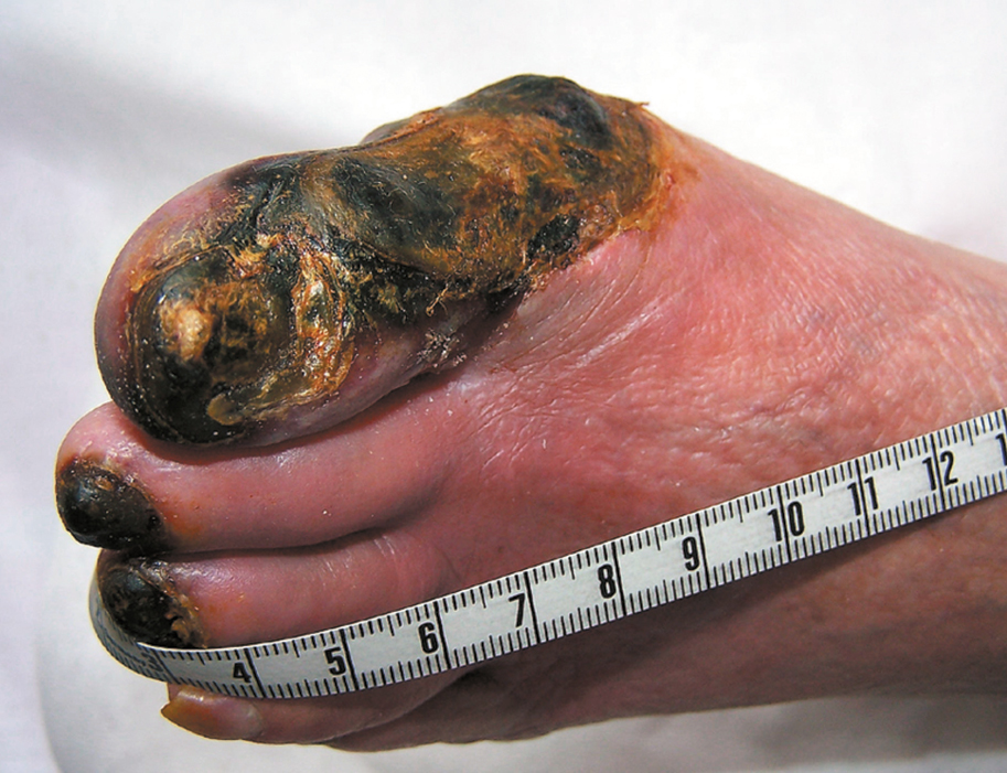 Figure 031_7399.  Dry gangrene of the toes due to chronic ischemia (critical ischemia).  Figure courtesy of Dr Leszek Masłowski.  