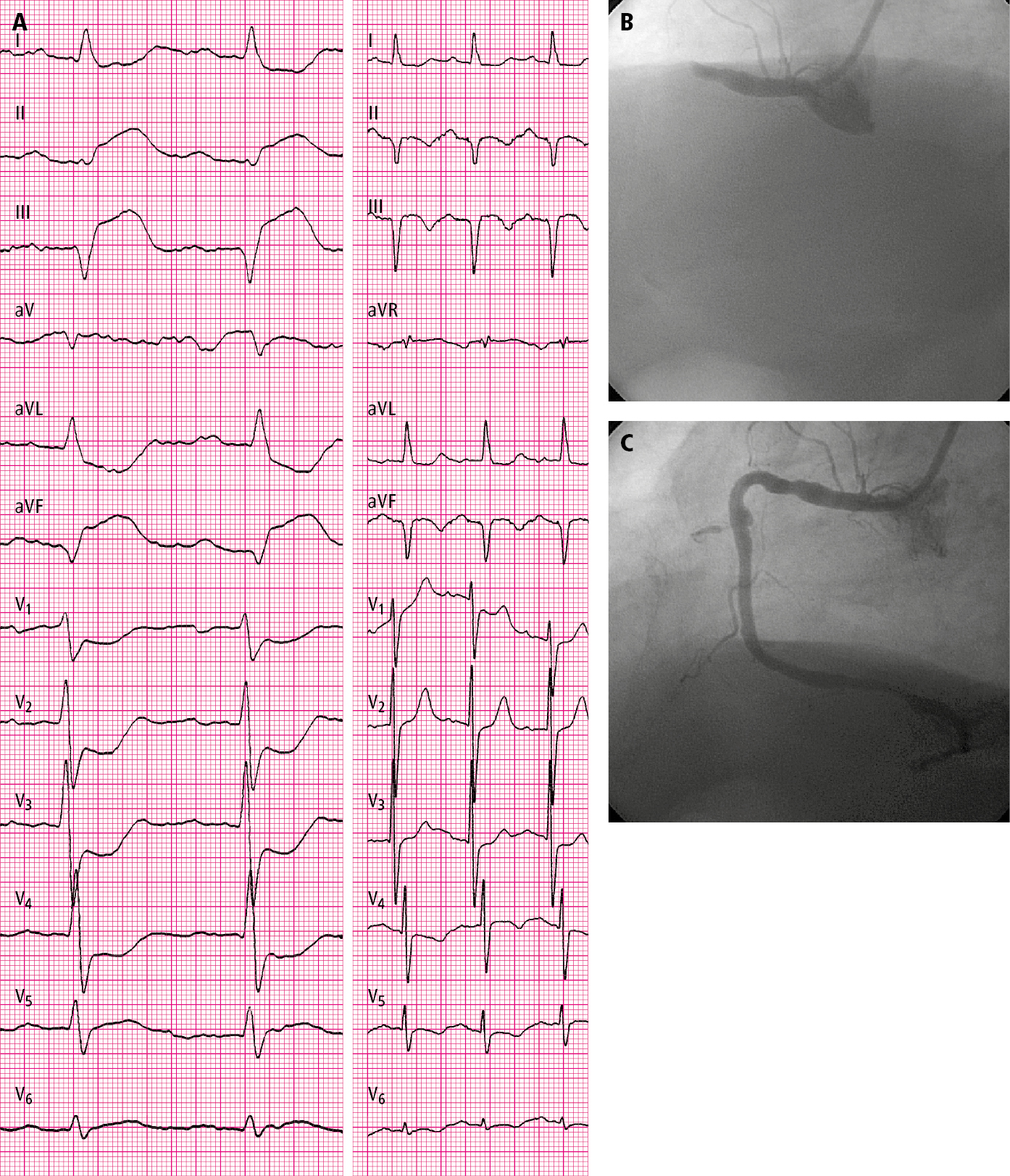 Figure 031_7447.  A 76-year-old patient hospitalized in the second hour of pain:   A  , electrocardiography (ECG) on admission (paper speed, 50 mm/s);   B  , coronary angiography: total occlusion of the right coronary artery before percutaneous coronary intervention (PCI);   C  , post-PCI coronary angiography: right coronary artery (TIMI grade 3 flow). 