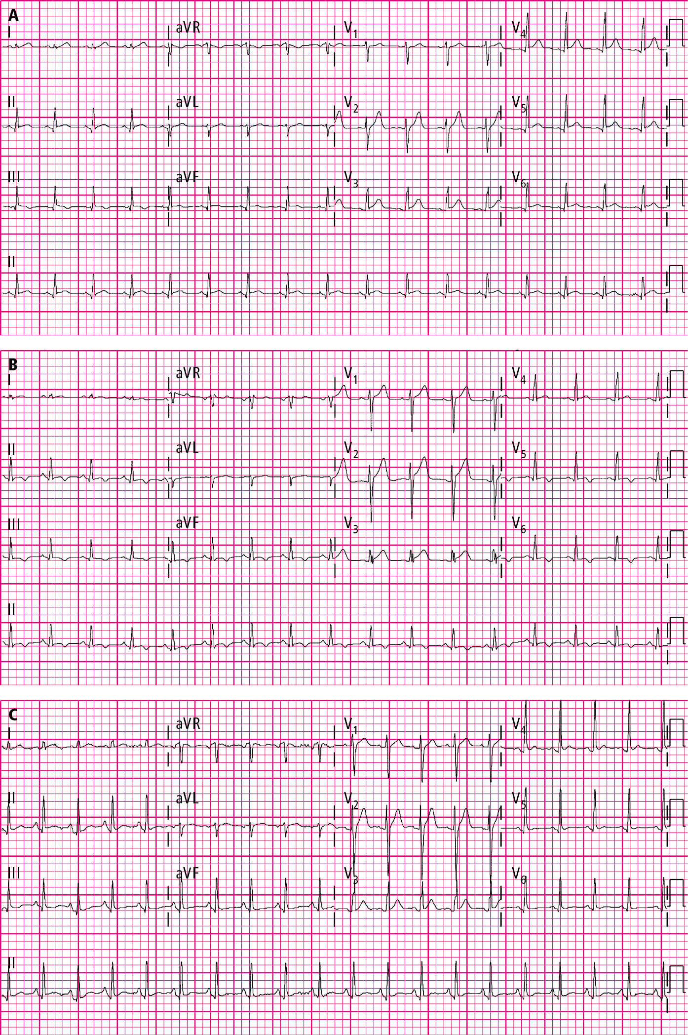 Figure 031_7505.  Classic electrocardiography (ECG) evolution in acute pericarditis. The initial ECG shows a diffuse ST-segment elevation and PR depression ( A ), which is followed by the resolution of the ST-segment elevation and then the presence of diffuse T-wave inversion ( B ), and lastly by improvement of all ECG changes ( C ).  Figures courtesy of Dr Hassan Mir.  