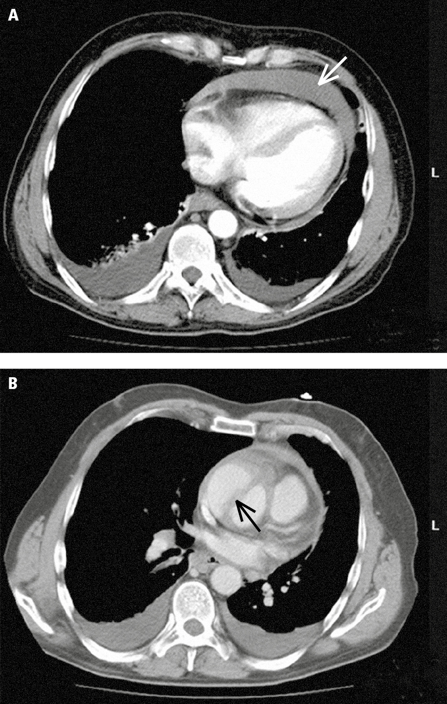 Figure 031_7563.  Multislice computed tomography (CT) in a patient with acute ascending aortic dissection:  A , pericardial effusion (white arrow) and pleural effusion (red arrows);  B , dissected ascending aorta (the arrow marks the dissection flap).  Figure courtesy of Dr   Jerzy Walecki . 