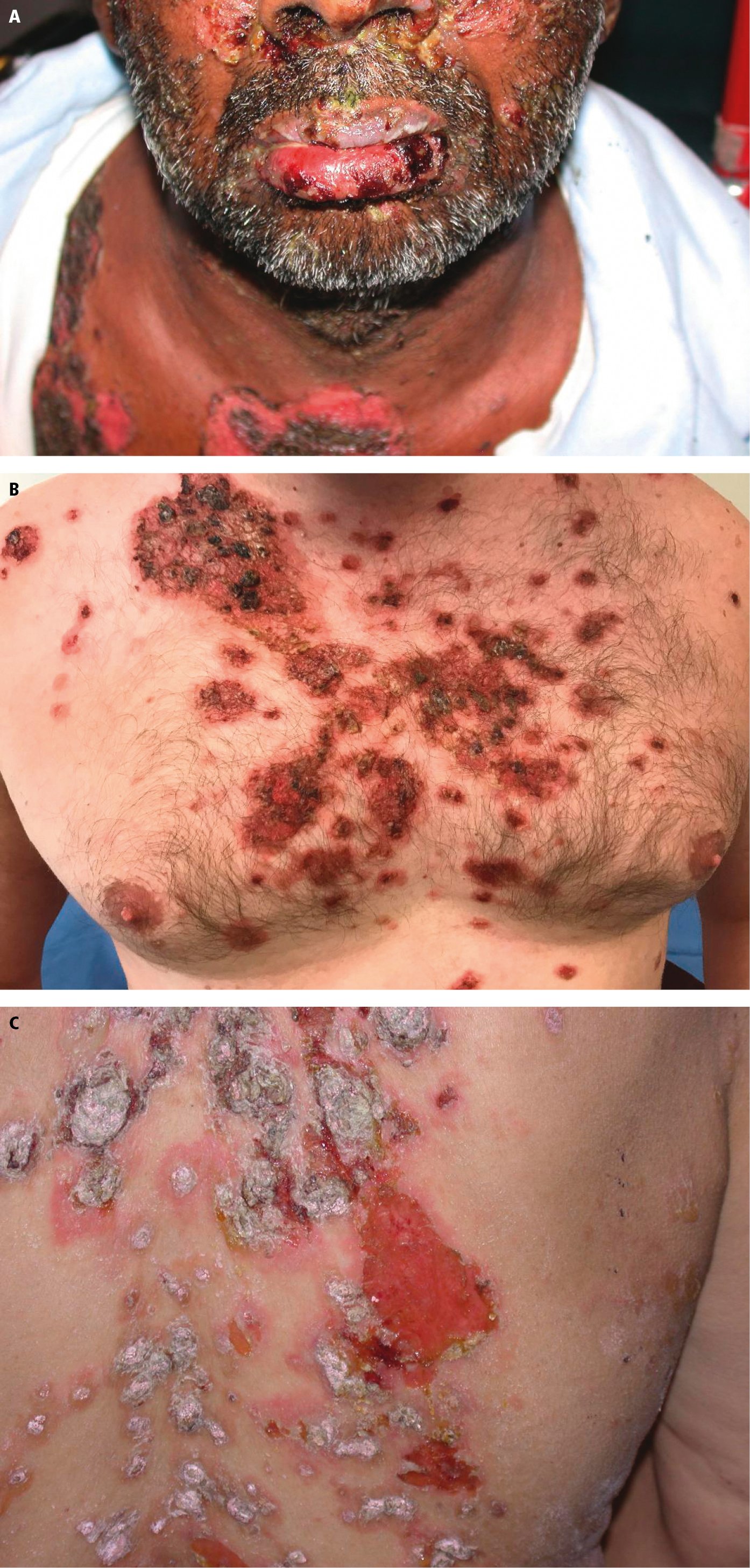 Figure 031_7753.  Pemphigus vulgaris.  A , diffuse facial and lip erosions and crusted plaques.  B , extensive flaccid blisters and erosions on the chest.  C , diffuse erosions and plaques on the back.  Photograph courtesy of Dr Scott Walsh.  