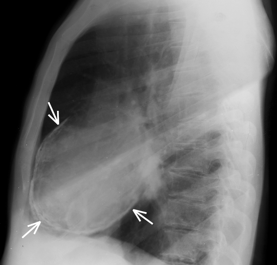 Figure 031_7800.  Chest radiography, lateral view: pericardial calcification (arrows). 