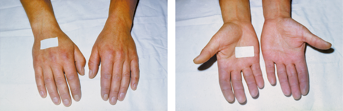 Figure 031_7829.  Raynaud phenomenon. Cyanosis affecting fingers of both hands.  Figure courtesy of Dr Leszek Masłowski.  