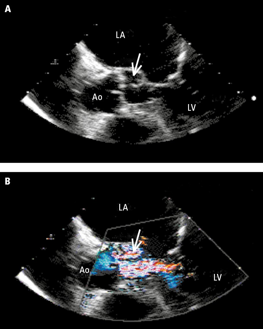 Figure 031_7931.  Transesophageal echocardiography (TTE):   A  , aortic valve (Ao) with a periaortic abscess (arrow);   B  , color Doppler ultrasonography showing a jet of aortic valve regurgitation flowing into the abscess. Ao, aorta; LA, left atrium; LV, left ventricle.  Figure courtesy of Dr Marek Krzanowski.  