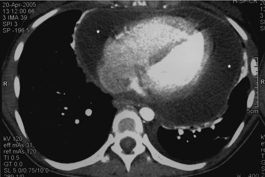 Figure 031_7989.  Chest computed tomography (CT): a large pericardial effusion (asterisks). 