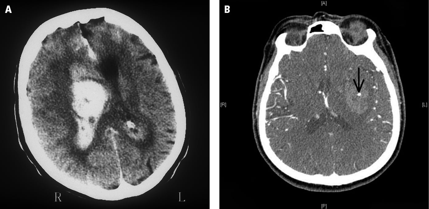 Figure 031_8074.   A , computed tomography (CT) of intracerebral hemorrhage to the right hemisphere with edema and midline shift;  B , contrast-enhanced CT of the spot sign (arrow), indicating persisting bleeding. 