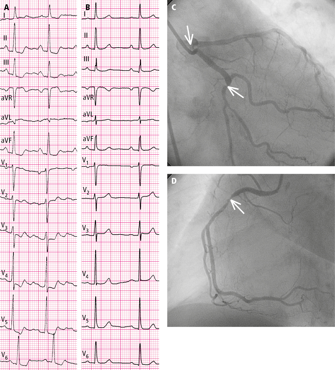 Figure 031_8182.  Resting electrocardiography (ECG) of a 67-year-old woman during a chest pain episode (  A  ; ST-segment depression in leads II, III, aVF, and V 4  through V 6 ) and after pain resolution (  B  ). Coronary angiography showed stenoses (arrows) at the origin of the left anterior descending artery (80%), in the left circumflex artery (90%;  C ), and in the right coronary artery (90%;  D ). 