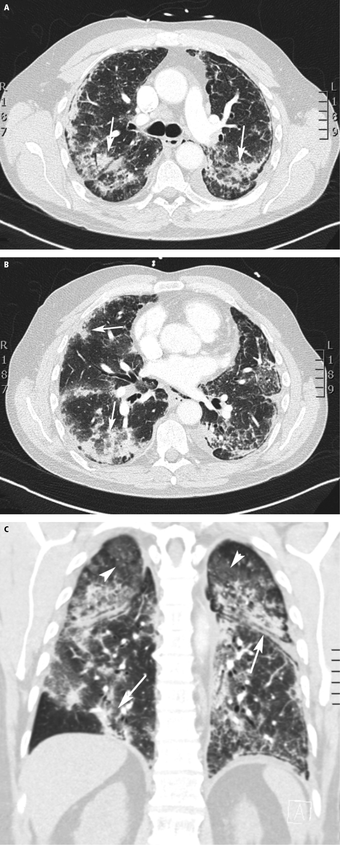 Figure 031_8222.  Computed tomography (CT) of a 65-year-old male patient (case #2) shows areas of consolidation (arrows) in axial ( A ,  B ) and coronal ( C ) planes. Rounded ground-glass opacities (arrowhead) and consolidation (arrows) are visible. 