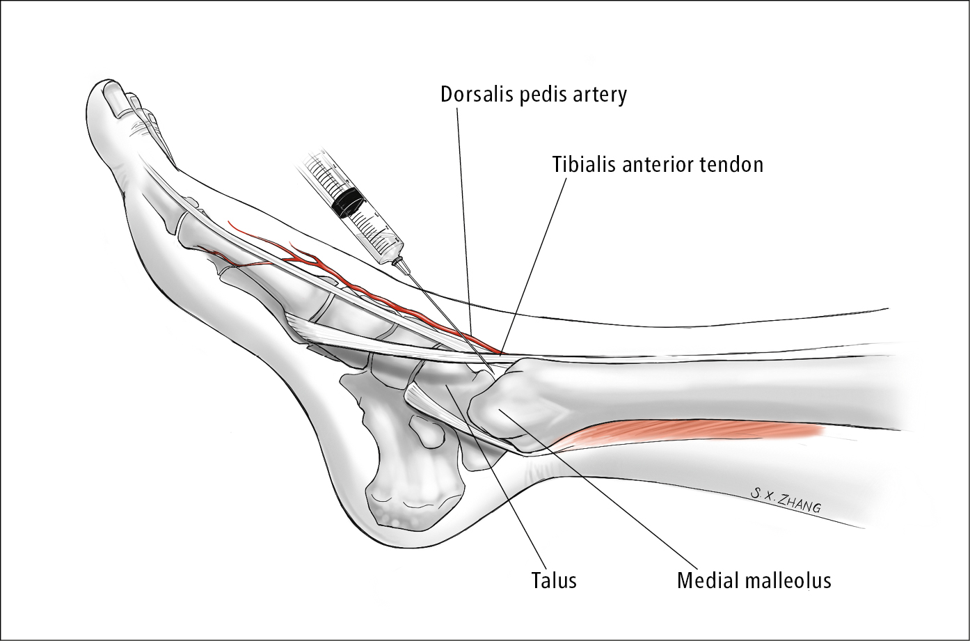 Figure 031_8266.  Ankle arthrocentesis.  Illustration courtesy of Dr Shannon Zhang.  