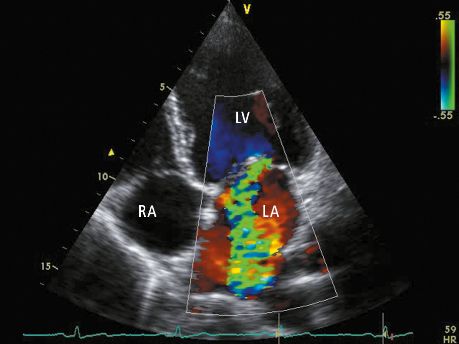Figure 031_8355.  Transthoracic echocardiography (TTE) (apical 4-chamber view): mitral regurgitation (regurgitation jet marked in green). LA, left atrium; LV, left ventricle; RA, right atrium. 