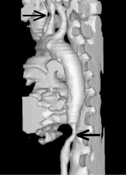 Figure 031_8532.  Takayasu arteritis: computed tomography (CT), 3D reconstruction. Stenosis of the left common carotid artery (thin arrow) and of the abdominal aorta (thick arrow).  Figure courtesy of Dr   Leszek Masłowski.  