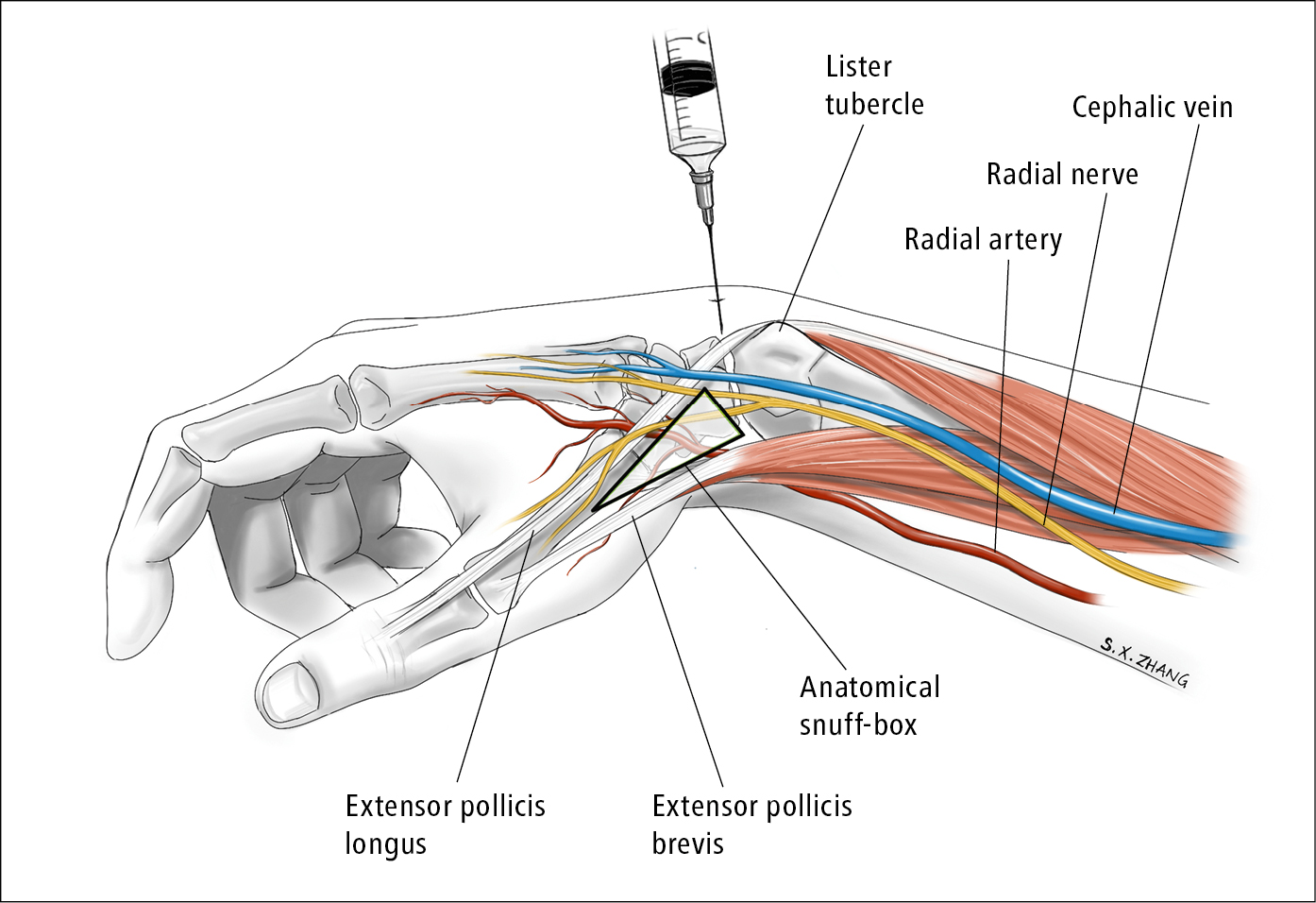 Figure 031_8617.  Wrist arthrocentesis.  Illustration courtesy of Dr Shannon Zhang.  
