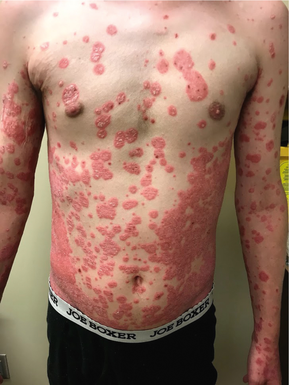 Figure 031_8635.  Diffuse plaque-type psoriasis.  Photograph courtesy of Dr Mohannad Abu-Hilal.  