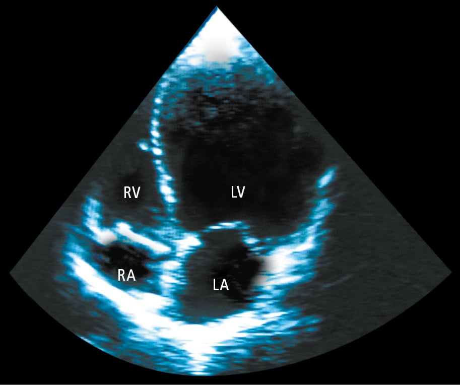 Figure 031_8641.  Echocardiography (apical 4-chamber view) of a patient with dilated cardiomyopathy showing significant left ventricular (LV) dilatation. LA, left atrium; RA, right atrium; RV, right ventricle. 