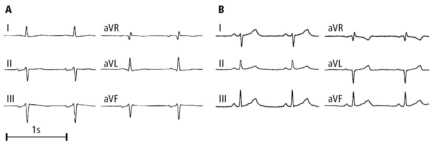 Figure 031_8663.  Electrocardiography (ECG) (limb leads) of patients with left fascicular block:   A  , left anterior fascicular block;   B  , left posterior fascicular block.  Figure courtesy of Dr Andrzej Stanke.  