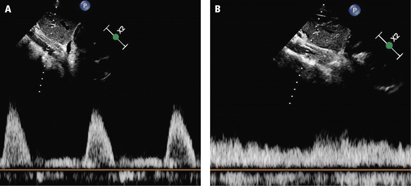 Figure 031_8684.  Abdominal aortic pulsed wave Doppler patterns:  A , normal pattern;  B , abnormal pattern of coarctation of the aorta.  Figure courtesy of Dr Manojkumar Rohit . 