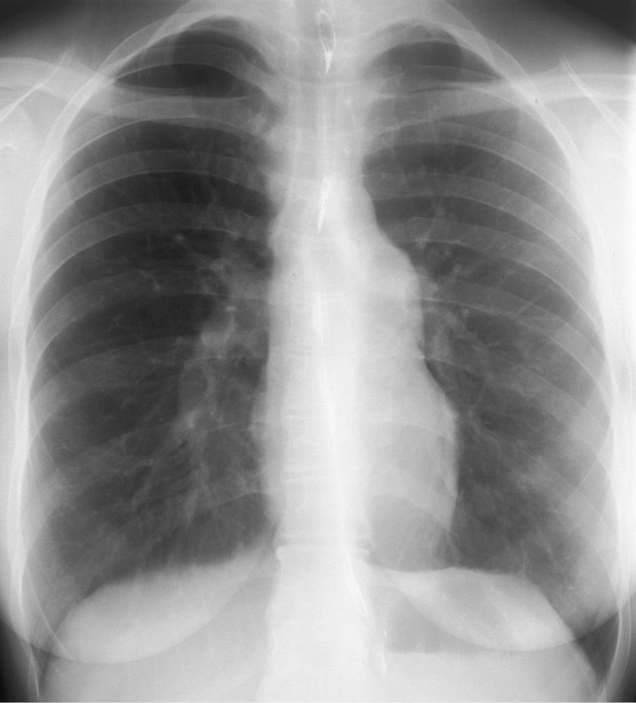 Figure 031_8709.  Chest radiography of a patient with Eisenmenger syndrome: a normal-sized cardiac silhouette, prominent main pulmonary artery, enlarged pulmonary arteries, diminished peripheral vascular markings. 