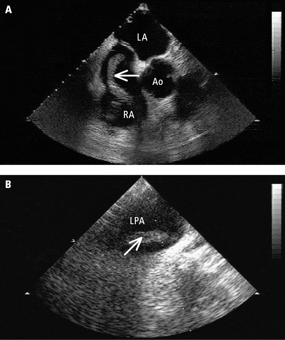 Figure 031_8750.  Transesophageal echocardiography (TEE):   A  , a mobile thrombus (arrow) in the right atrium (RA);   B  , a thrombus (arrow) in the left pulmonary artery (LPA). Ao, aorta; LA, left atrium. 