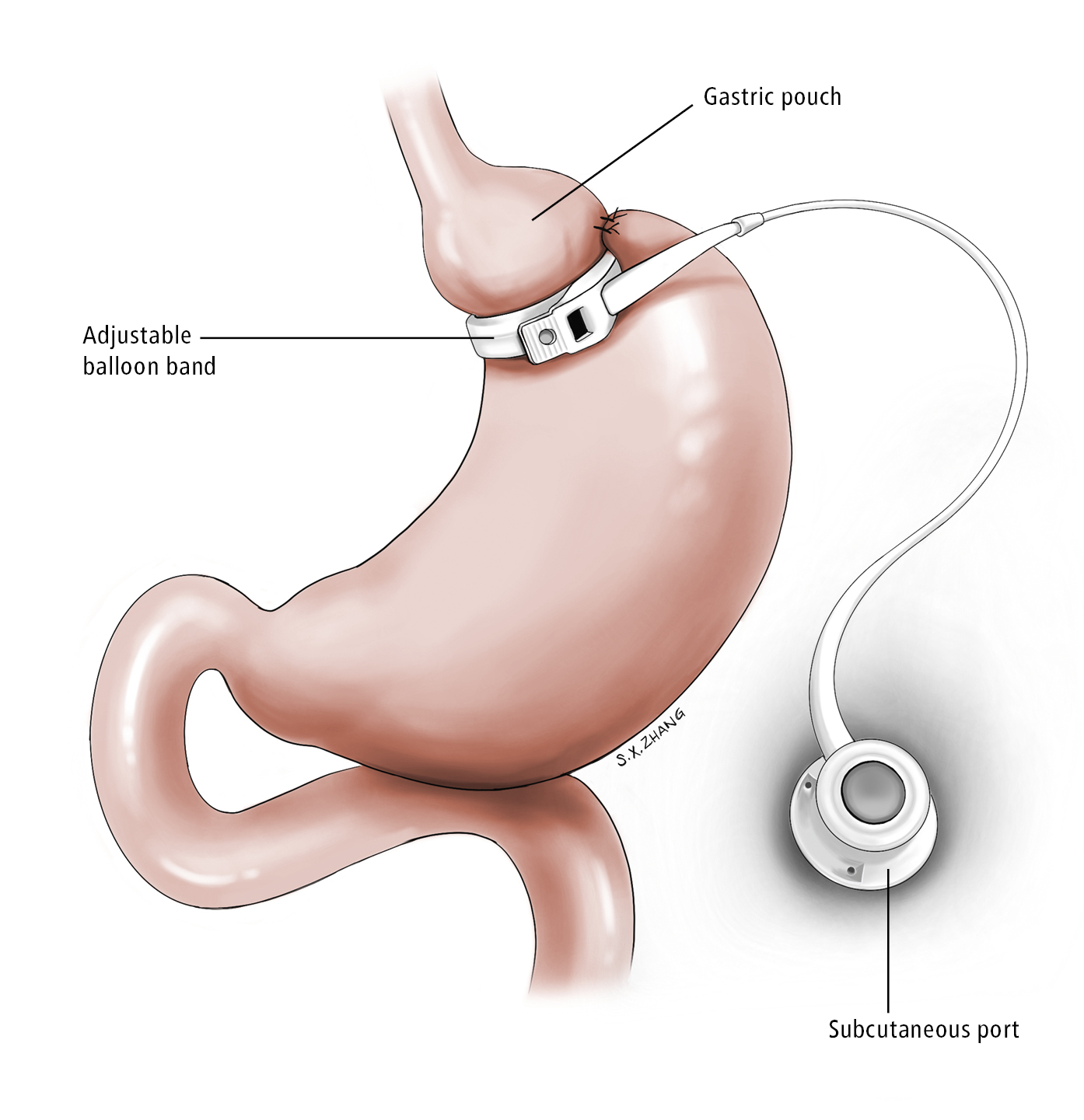 Figure 031_8858.  Gastric band.  Illustration courtesy of Dr Shannon Zhang.  