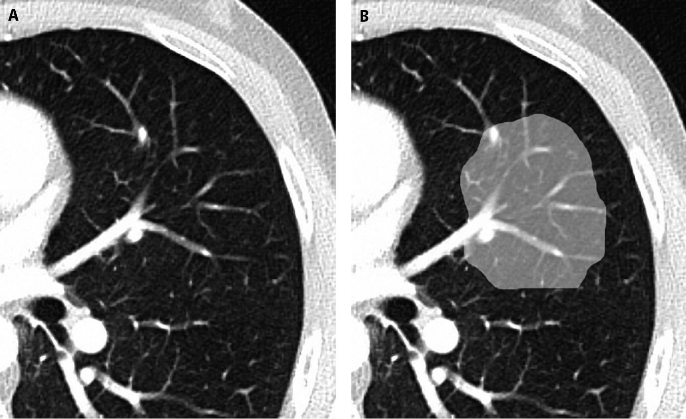 Figure 031_8900.  Axial computed tomography (CT) of the thorax showing a normal lung ( A ) and ground-glass opacity ( B ). Note that normal lung structures remain visible despite the opacity. Figure manipulated to enhance learning points using image editing software. 