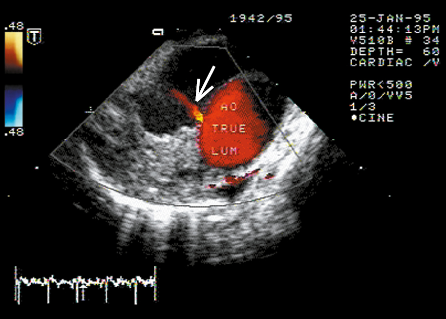 Figure 031_8998.  Descending aortic dissection. Transesophageal color Doppler ultrasonography reveals flow from the true lumen through the intimal tear (arrow).  Figure courtesy of Dr Marek Krzanowski.  