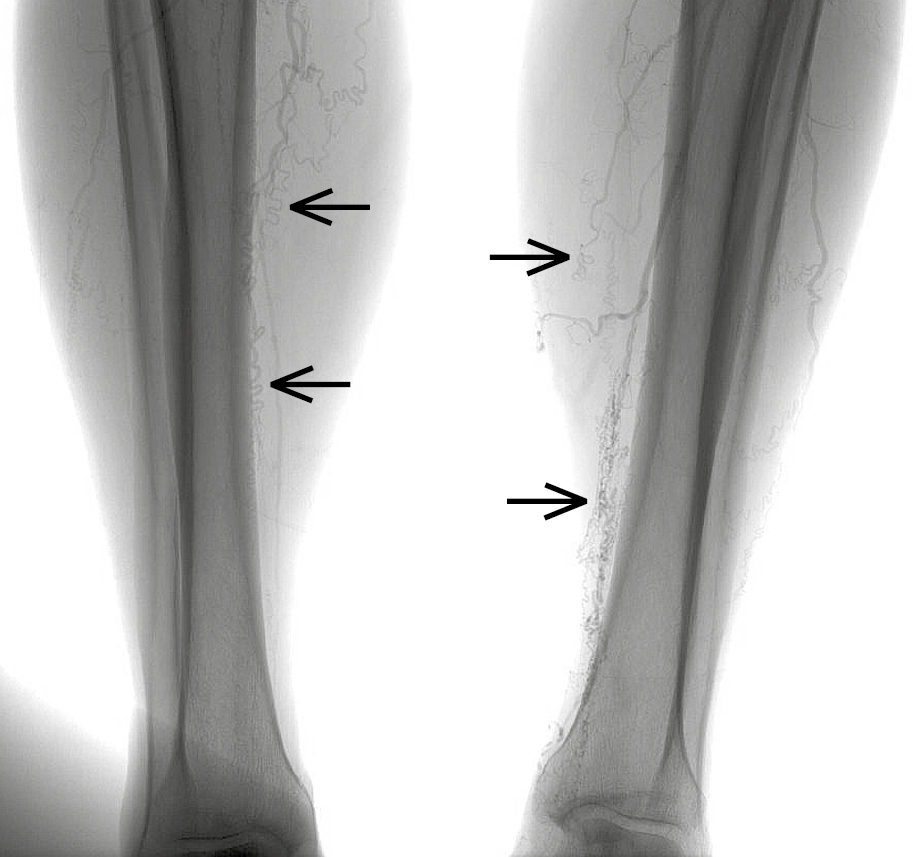 Figure 031_9000.  Thromboangiitis obliterans. Arteriography reveals occluded arteries of the lower leg and typical corkscrew-shaped collateral arteries (arrows). 