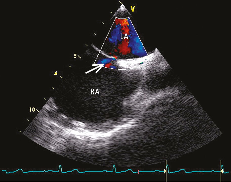Figure 031_9044.  Transesophageal echocardiography (TEE) with color Doppler, longitudinal view: shunt across a patent foramen ovale (PFO) (arrow). LA, left atrium; RA, right atrium. 