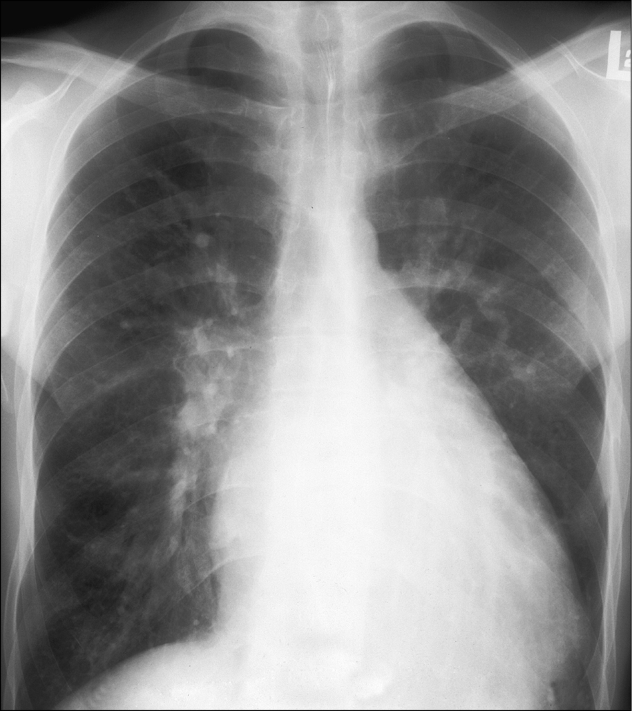 Figure 031_9072.  Chest radiography of a patient with ventricular septal defect (VSD): dilatation of the left ventricle, main pulmonary artery, and pulmonary arteries; features of increased pulmonary blood flow; narrow ascending aorta.  Figure courtesy of Dr Piotr Hoffman.  