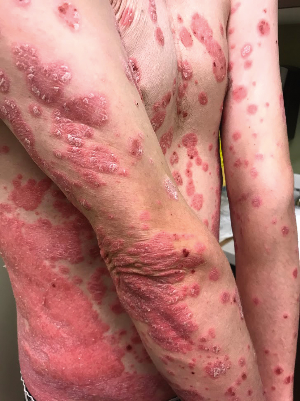 Figure 031_9170.  Plaque-type psoriasis with well-defined erythematous plaques with whitish-silvery scales.  Photograph courtesy of Dr Mohannad Abu-Hilal.  
