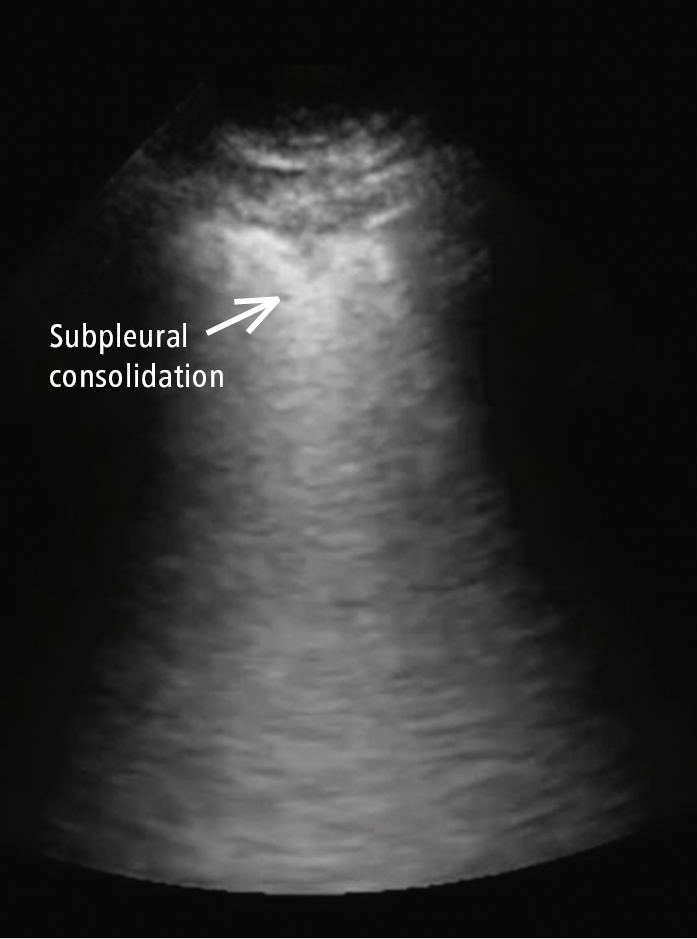 Figure 031_9173.  Nontranslobar consolidation (subpleural consolidation; arrow) in COVID-19, in addition to the thick irregular pleural line with discontinuity. 