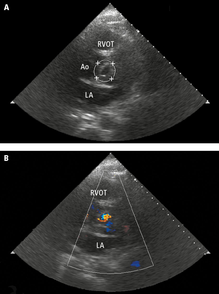 Figure 031_9189.  Transthoracic echocardiography (TTE): the parasternal short-axis view at the level of the aortic valve.   A  , left coronary leaflet perforation (circle).   B  , color Doppler ultrasonography showing a jet of aortic regurgitation through the perforated leaflet. Ao, aorta; LA, left atrium; RVOT, right ventricular outflow tract. 
