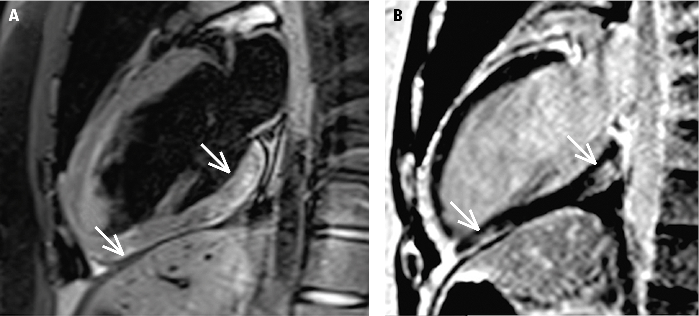 Figure 031_9201.  Cardiac magnetic resonance imaging (MRI) of a patient with suspected acute myocarditis, 2-chamber view. Both MRI criteria for acute myocarditis are met.   A  , features of myocardial edema (high signal intensity of the basal and apical inferior myocardial segments; arrows), the T2-dependent criterion.   B  , presence of the typical subepicardial late gadolinium enhancement in the area corresponding to the area of the edema (arrows), the T1-dependent criterion.  Figure courtesy of Dr Łukasz Małek.  